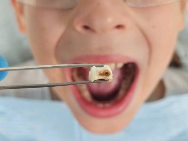 Best Knocked-Out Tooth (Avulsed Tooth) Treatment in Davie, FL